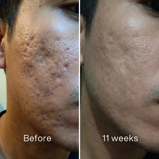 Acne Scar Invisible Repair Stick