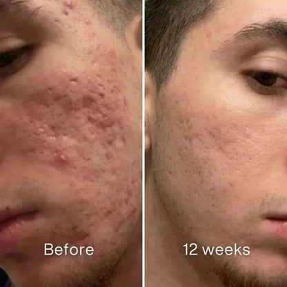 Acne Scar Invisible Repair Stick
